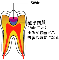 罹患歯質